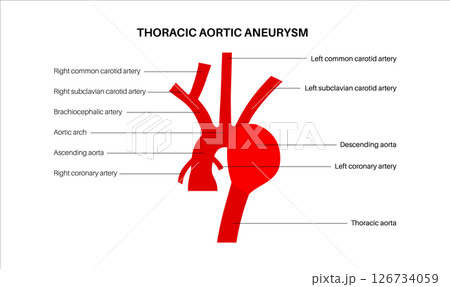 Thoracic aortic aneurysm 126734059