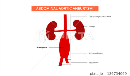Abdominal Aortic Aneurysm 126734069