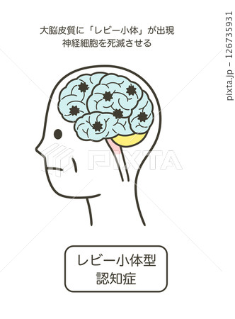 レビー小体型認知症によって損傷を受ける脳の部分とその名称のイラスト 126735931
