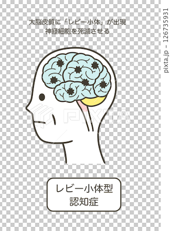 レビー小体型認知症によって損傷を受ける脳の部分とその名称のイラスト 126735931