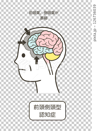 額顳葉失智症受損的大腦部位圖解及其名稱 額顳葉失智症受損的大腦部位圖解及其名稱 126736039