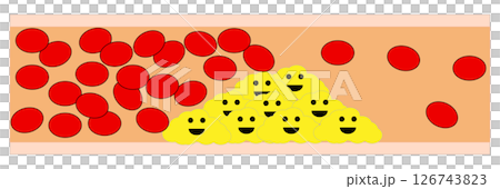 Arteriosclerosis illustration 126743823
