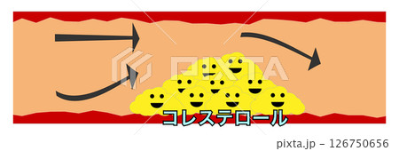 動脈硬化　イラスト 126750656
