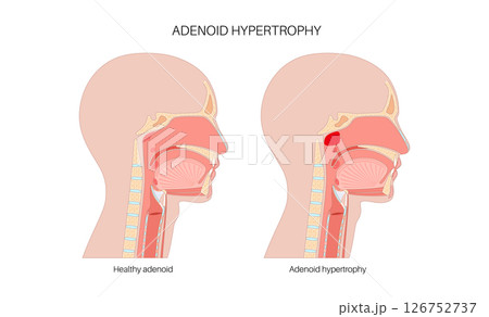 Enlarged adenoids poster 126752737