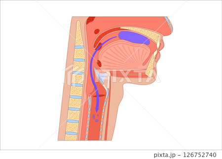 Aspiration pneumonia infection Aspiration pneumonia infection 126752740