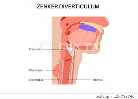 Pharyngoesophageal diverticulum poster Pharyngoesophageal diverticulum poster 126752746
