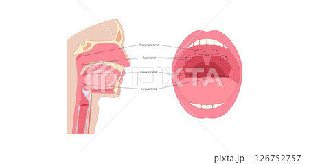 Adenoid medical poster Adenoid medical poster 126752757