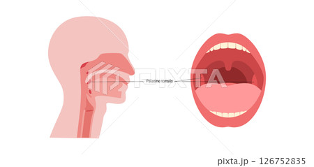 Palatine tonsils poster Palatine tonsils poster 126752835