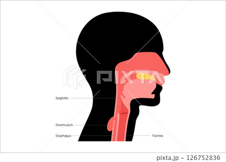 Pharyngoesophageal diverticulum poster Pharyngoesophageal diverticulum poster 126752836