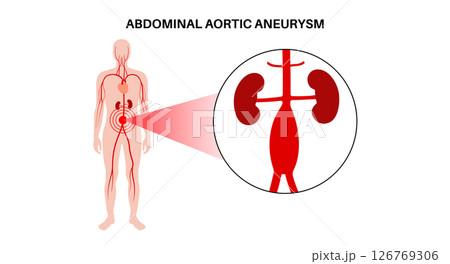 Abdominal Aortic Aneurysm Abdominal Aortic Aneurysm 126769306