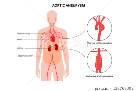 Abdominal Aortic Aneurysm 126769308