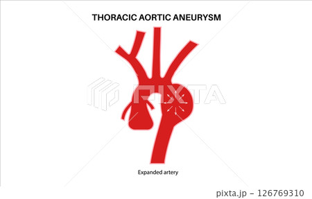Thoracic aortic aneurysm Thoracic aortic aneurysm 126769310