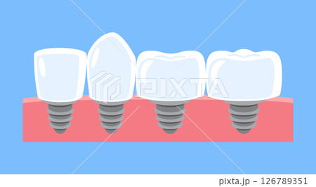 Dental implant . Type of teeth include incisor, canine, premolar and molar . Tooth cartoon illustration . Isolated on blue background . Flat design . Vector . 126789351