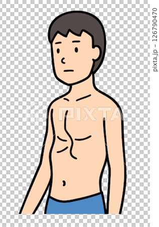 男性漏斗胸、胸部畸形 126790470