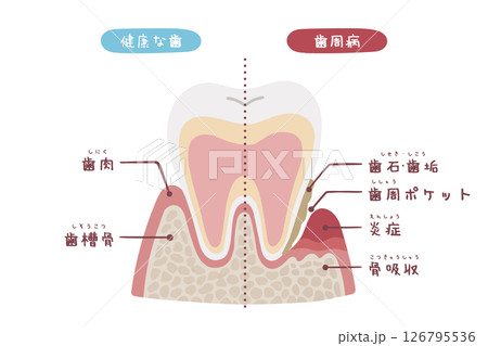 手描きの健康な歯と歯周病の歯の断面図のイラスト 手描きの健康な歯と歯周病の歯の断面図のイラスト 126795536