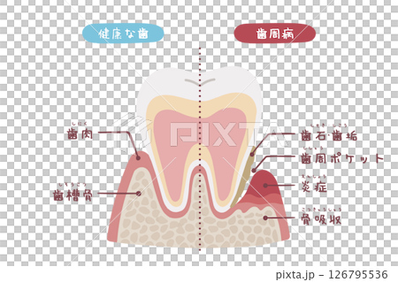 健康牙齒和患有牙周病的牙齒橫切面手繪插圖 126795536