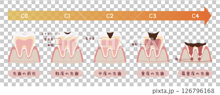蛀牙過程的圖示 126796168