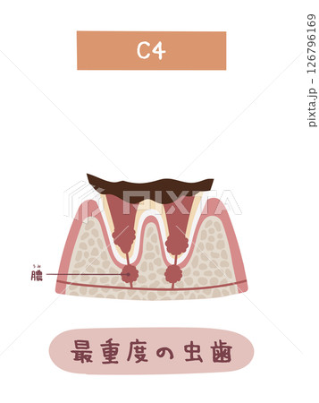 虫歯になる過程のC4のイメージイラスト 126796169