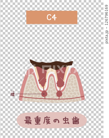 蛀牙過程中 C4 的圖示 蛀牙過程中 C4 的圖示 126796169