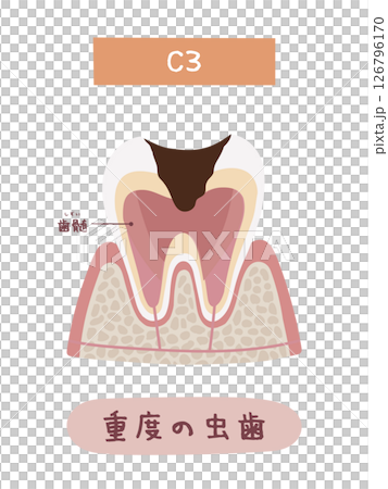 虫歯になる過程のC3のイメージイラスト 126796170