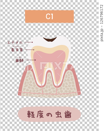 C1 蛀牙過程的圖示 C1 蛀牙過程的圖示 126796172