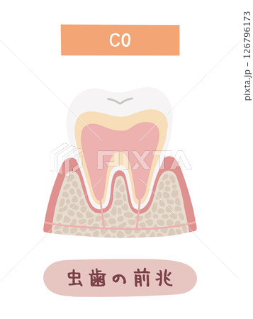 虫歯になる過程のC0のイメージイラスト 126796173