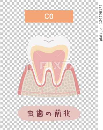虫歯になる過程のC0のイメージイラスト 126796173
