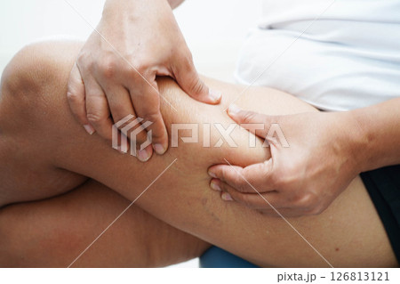 Asian woman with cellulite on leg skin fat, overweight problem. 126813121
