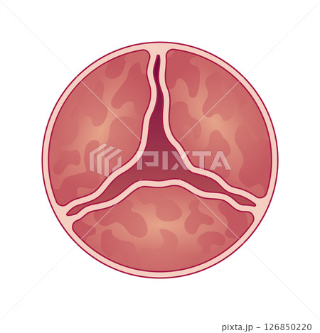 Medical illustration shows aortic valve with stenosis. Vector illustration 126850220