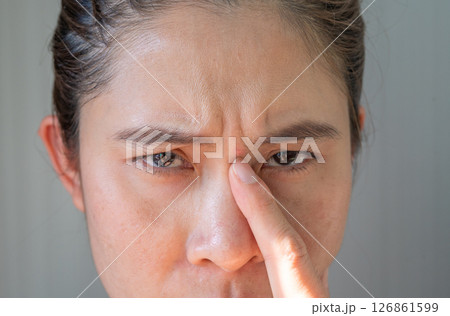 Portrait of unhappy Asian woman pointing to an acne occur between her eyebrows. Allergies, irritants, genetic makeup, etc can cause skin conditions. 126861599
