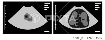 Ultrasound scan showing dizygotic twins during pregnancy 126863507