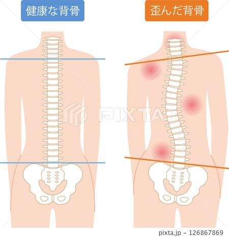 歪んだ背骨　正常な背骨　女性 126867869