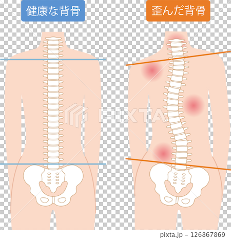 脊椎扭曲 正常脊椎 女性 脊椎扭曲 正常脊椎 女性 126867869