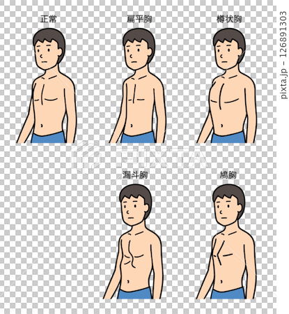 男性正常胸、扁平胸、桶狀胸、漏斗胸和鴿子胸的比較 126891303