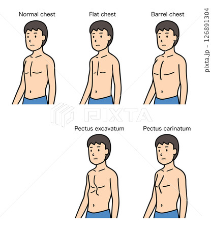 男性の胸郭、正常、扁平胸、樽状胸、漏斗胸、鳩胸の比較 126891304