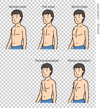 男性の胸郭、正常、扁平胸、樽状胸、漏斗胸、鳩胸の比較 126891304