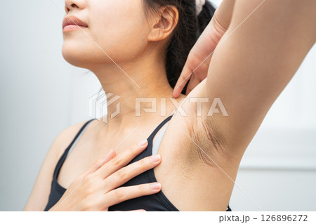 Asian woman have problem black armpit beauty skin care. 126896272