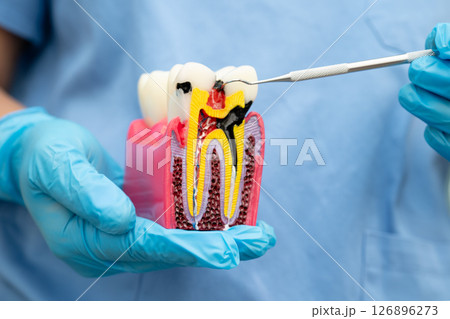 Teeth root dental model with tool for dentist use to cleaning care treatment. 126896273