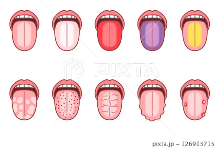 舌診、さまざまな症状の舌 126913715