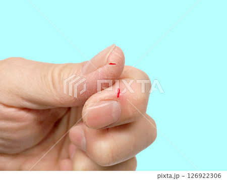 ひび割れ　あかぎれ　皮膚の乾燥　痛み 126922306