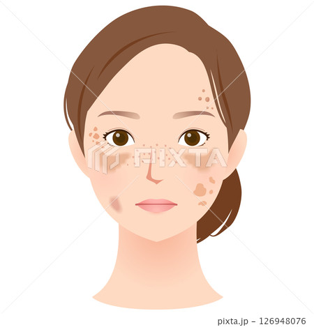 シミができた女性の顔　美容 126948076