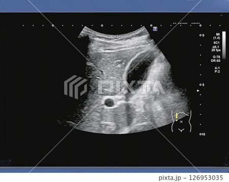 肝臓エコー検査の医療用素材 肝臓エコー検査の医療用素材 126953035