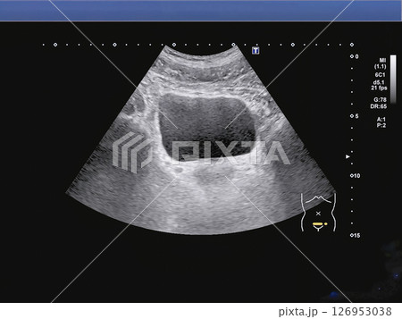 人間ドックでの膀胱エコー検査 人間ドックでの膀胱エコー検査 126953038