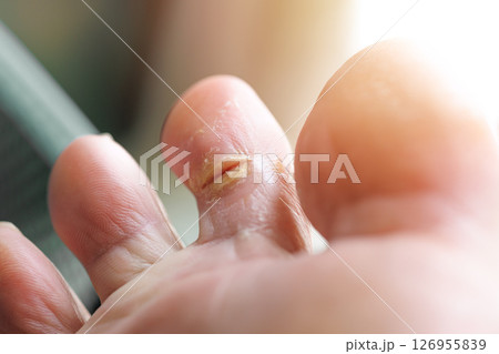Dry, cracked toe wounds infection wet moist feet skin fungi, Athlete foot tinea pedis 126955839