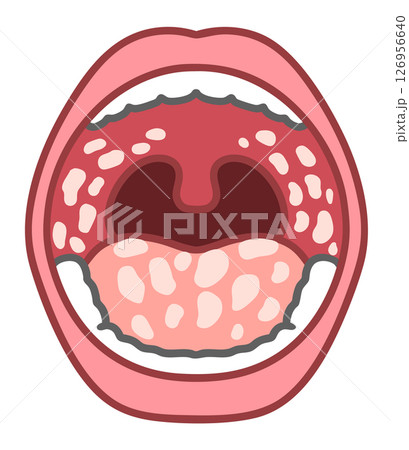口腔カンジダ症の口腔内：真菌感染症の視覚的特徴 126956640