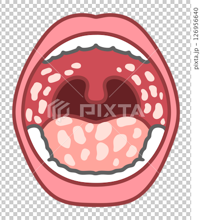 口腔カンジダ症の口腔内：真菌感染症の視覚的特徴 126956640