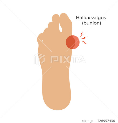 Silhouette of a human foot with a Hallux valgus deformation. Bunion of a big toe. Vector illustration Silhouette of a human foot with a Hallux valgus deformation. Bunion of a big toe. Vector illustration 126957430