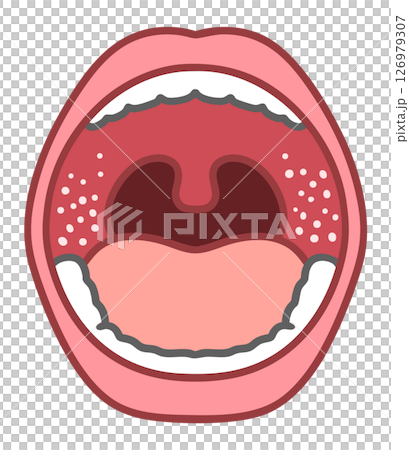 Illustration of measles in the mouth and Koplik spots 126979307