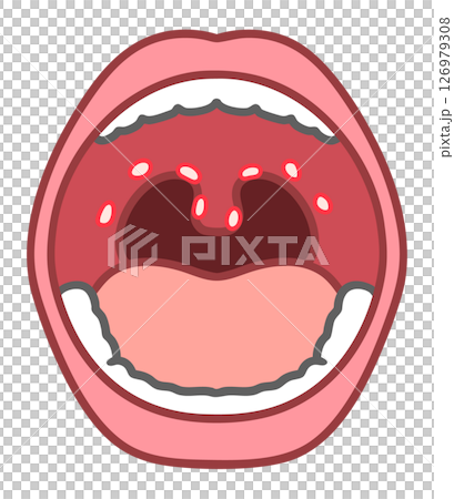 ヘルパンギーナの口腔内 126979308