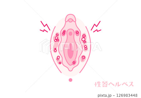 性器ヘルペスのある女性器（外陰部） 126983448